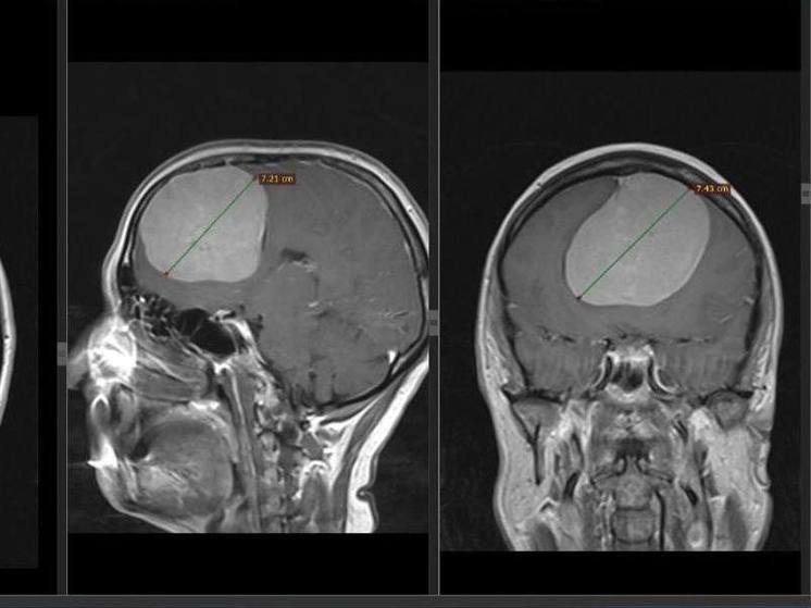 Ставропольские врачи удалили опухоль размером с большой кулак в мозге пациентки