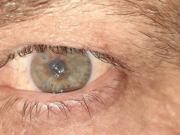 Ставропольские врачи восстановили хрусталик глаза пациенту