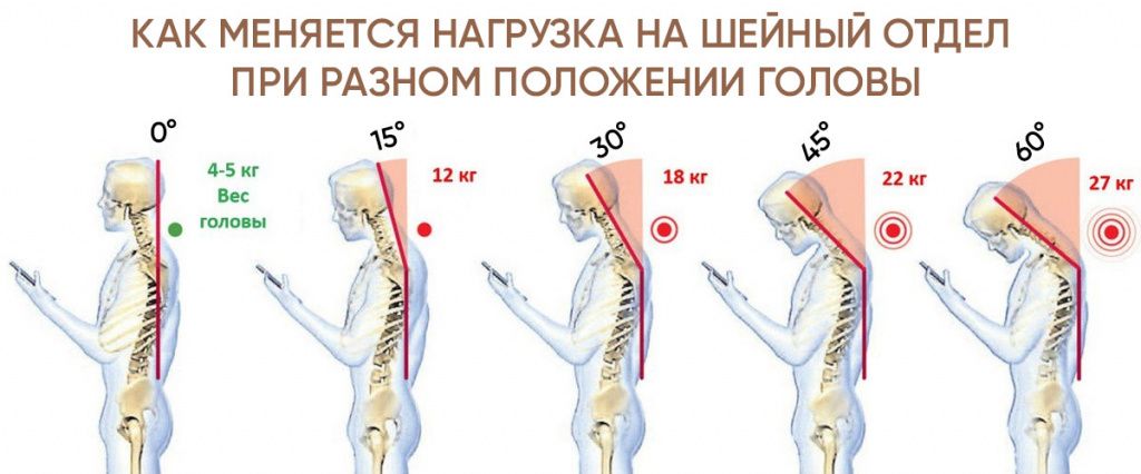 Чем шея геймера отличается от компьютерной и чем грозит просмотр сериалов на смартфоне2