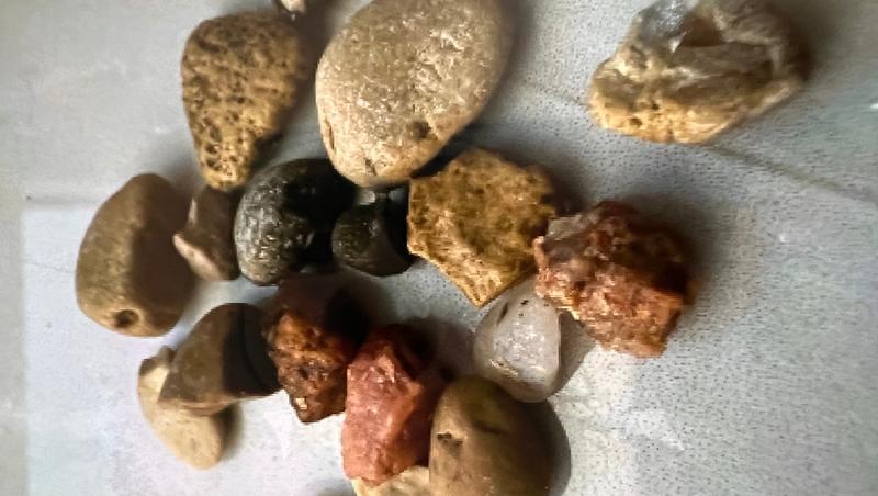 Врачи в Ессентуках помогли трёхлетнему ребёнку, который съел 25 камней