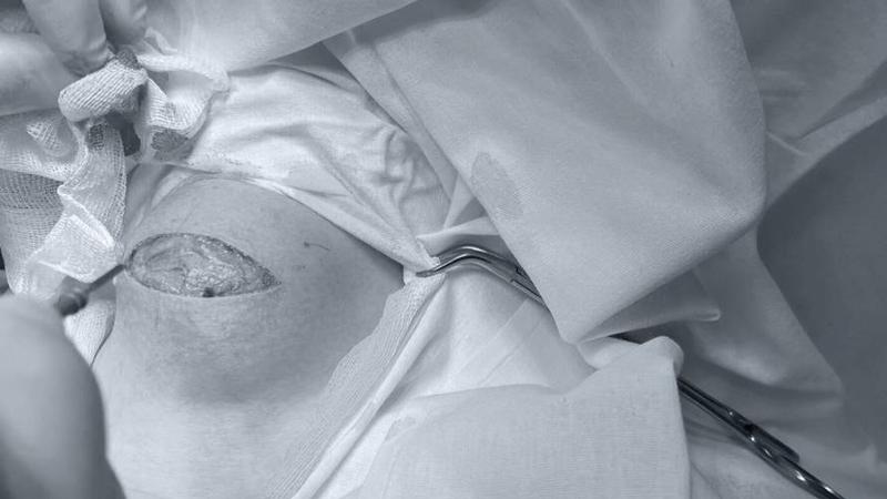 Кисту шеи размером с яблоко вырезали у подростка в Пятигорске