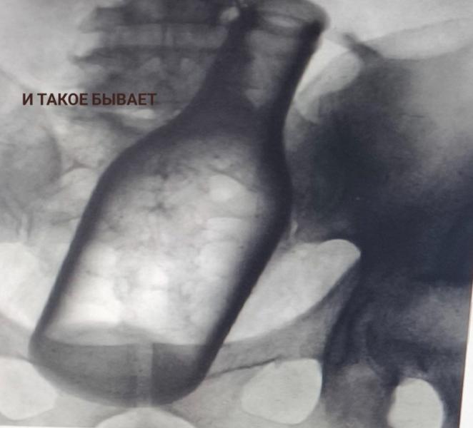 Бутылку и батарейки достали из пациентов врачи в Пятигорске