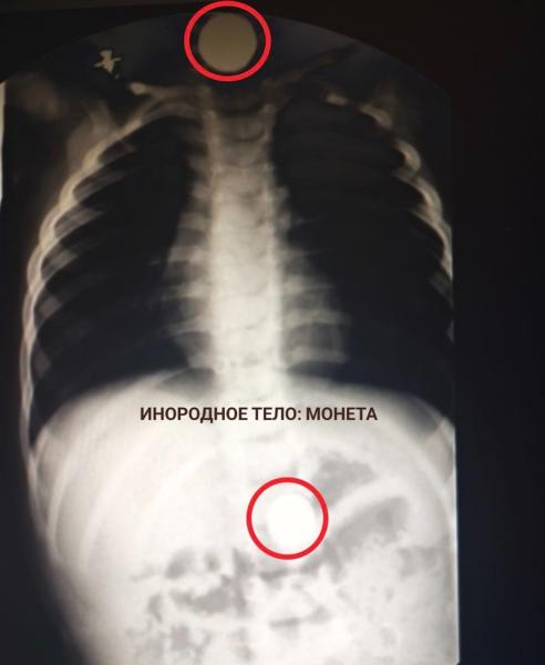 Бутылку и батарейки достали из пациентов врачи в Пятигорске